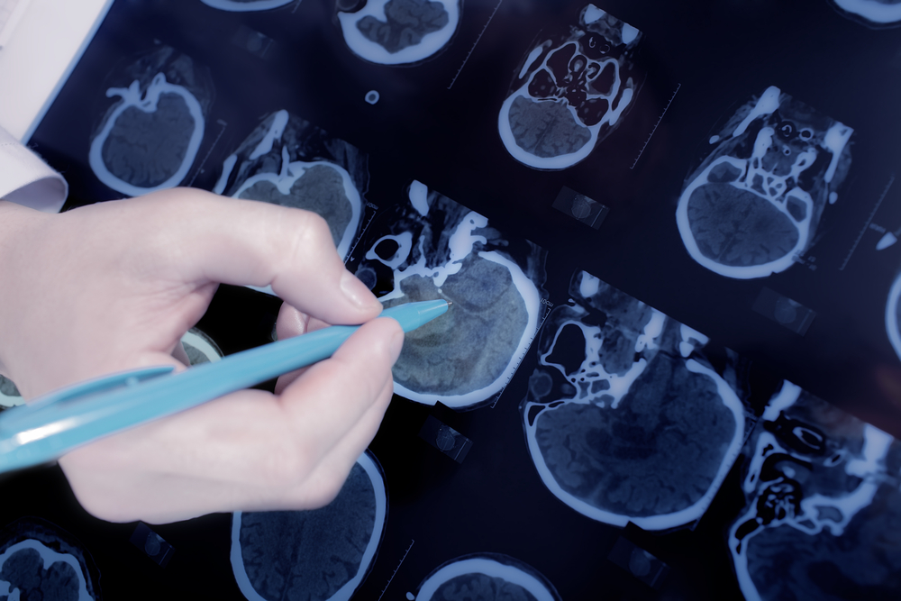 L'utilità della Spet nella diagnosi della Malattia di Parkinson L'utilità della Spet nella diagnosi della Malattia di Parkinson
