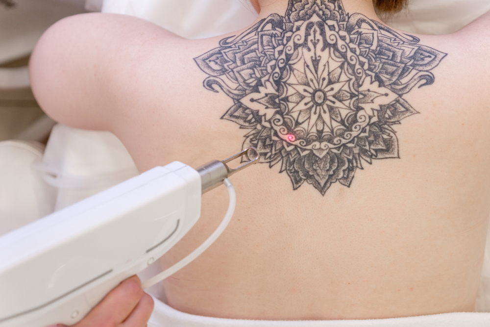 Rimozione tatuaggi: cosa occorre sapere