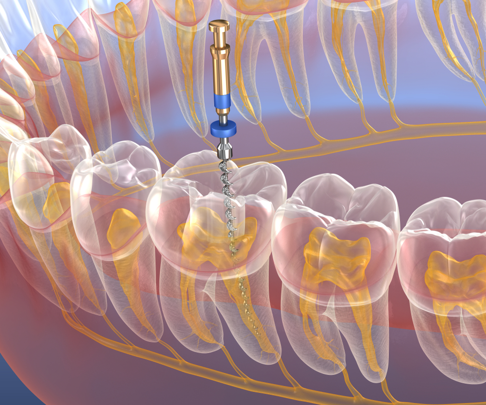 Endodonzia: la cura canalare Endodonzia: la cura canalare