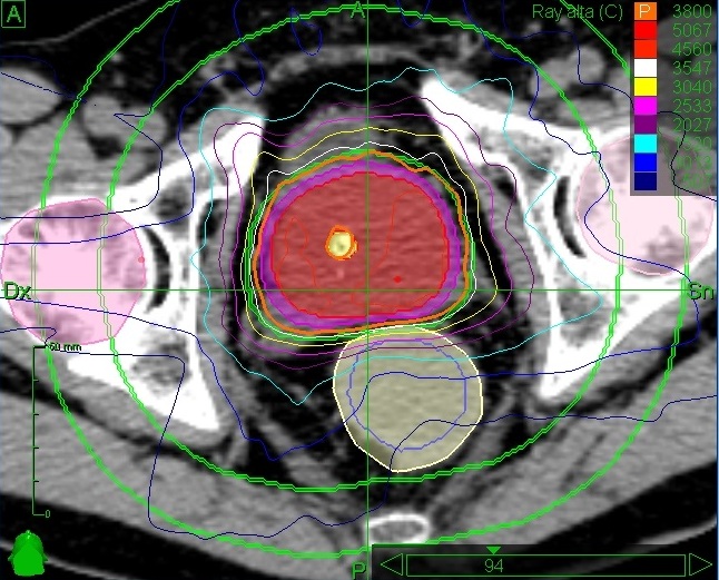 tumore prostata cdi esami di laboratorio