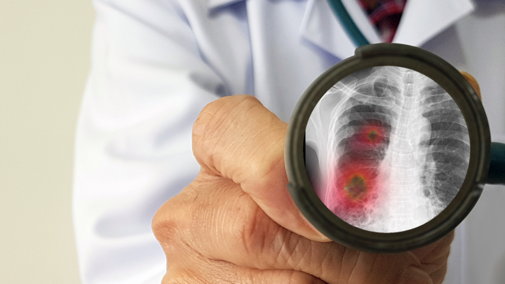 Le polmoniti: come si classificano, le cause e le modalità di contagio