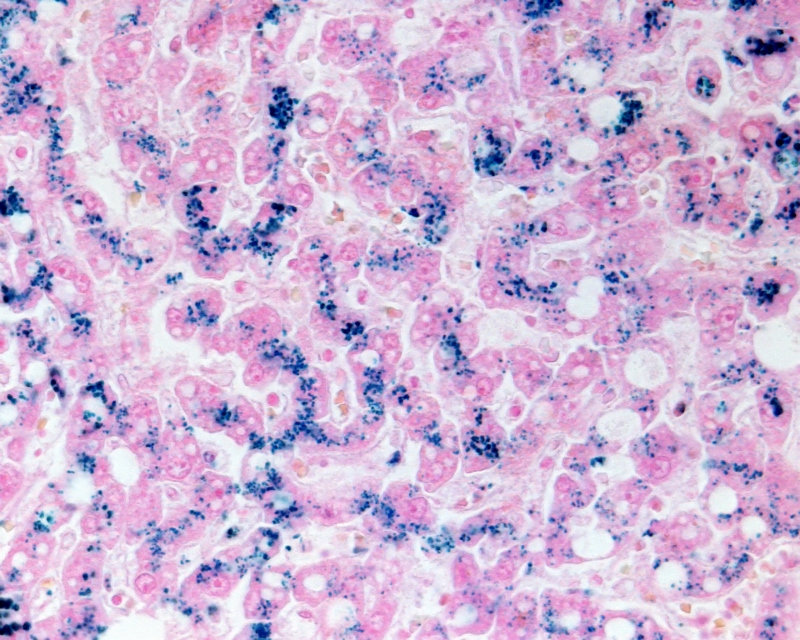 L'Emocromatosi Ereditaria (EE) L'Emocromatosi Ereditaria (EE)