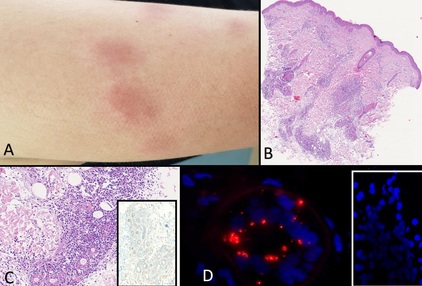 Covid-19: trovato il paziente zero italiano che presentava come unico sintomo una dermatosi a novembre 2019 Covid-19: trovato il paziente zero italiano che presentava come unico sintomo una dermatosi a novembre 2019