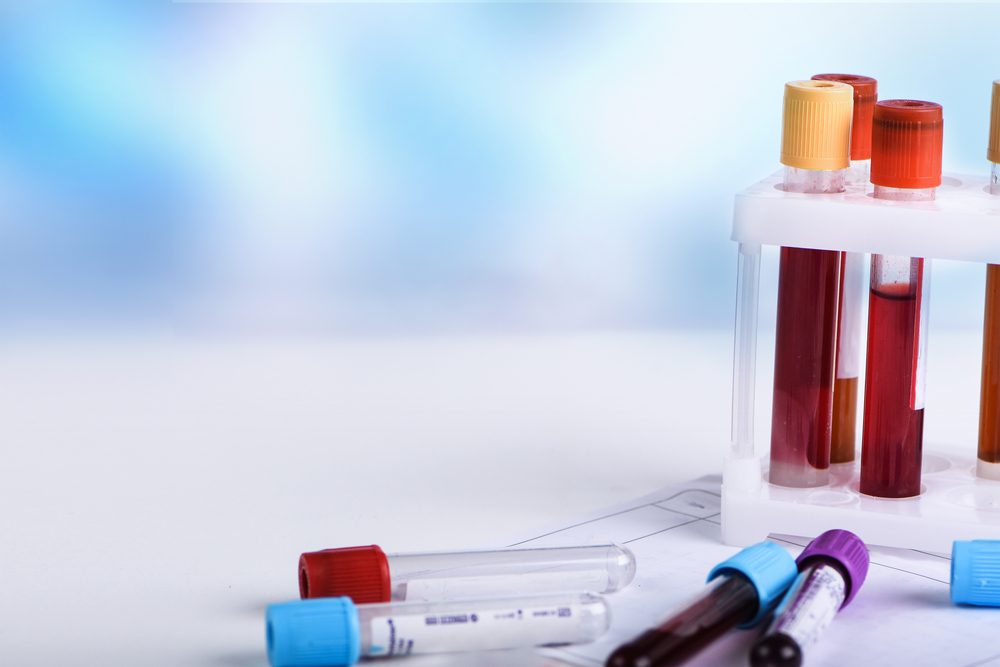 Test sierologico dopo la vaccinazione anti-covid Test sierologico dopo la vaccinazione anti-covid