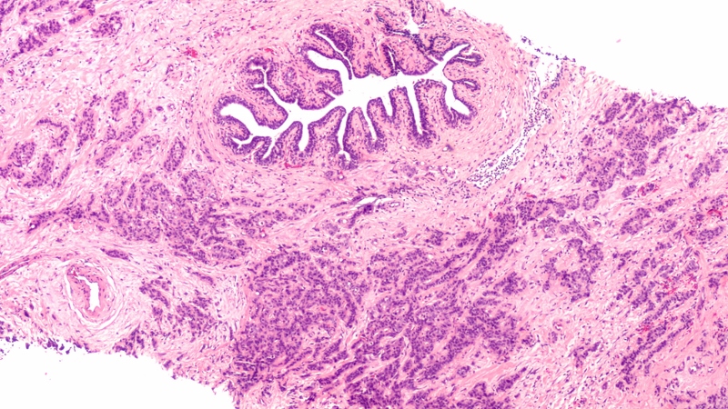 Biopsia della Mammella ora anche presso CDI Navigli