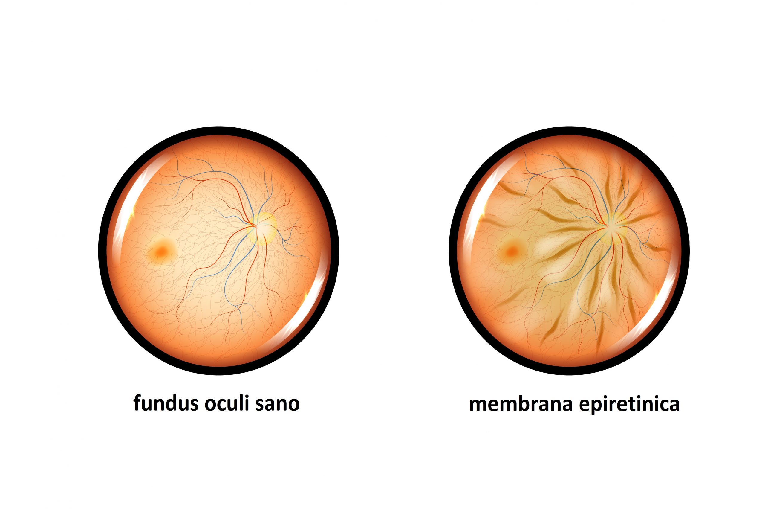 Le patologie vitreo-retiniche Le patologie vitreo-retiniche