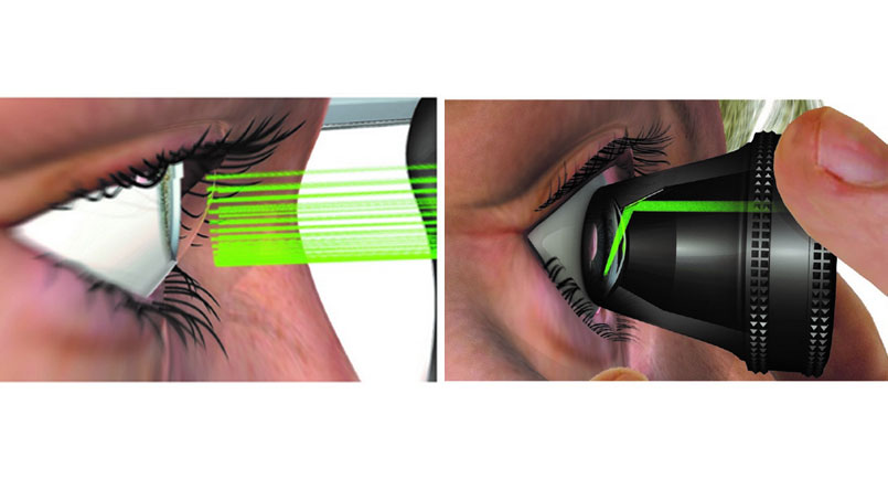 Metodo innovativo e non invasivo riduce la pressione oculare in maniera efficace e indolore, senza colliri.